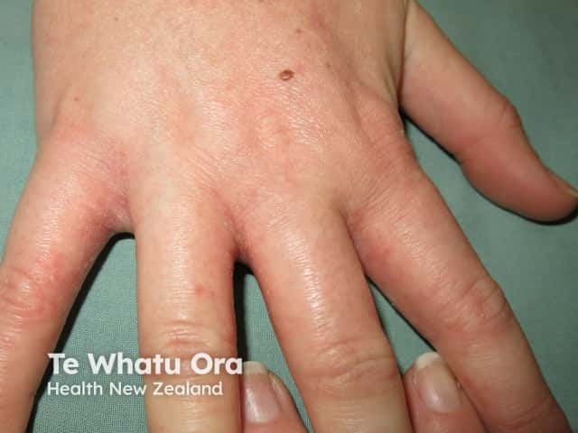 Hand dermatitis