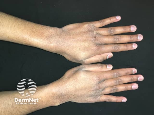 Atopic hand dermatitis