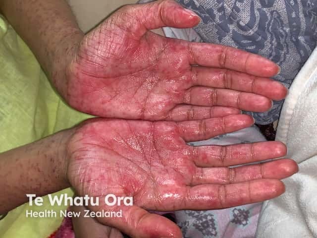 Suspected COVID-19 rash