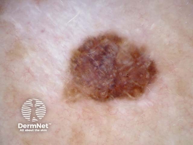 Melanoma in situ, polarised dermoscopy view