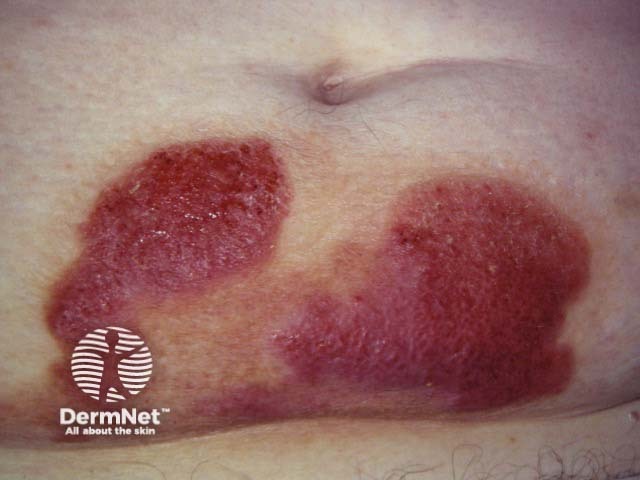 Cutaneous lymphoma