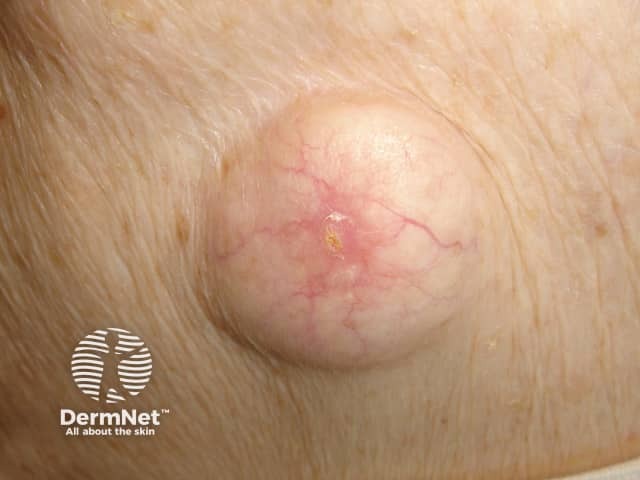 Epidermoid cyst