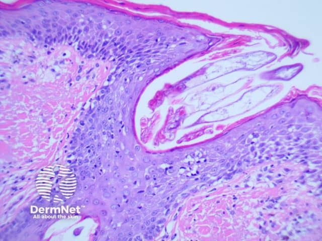 Demodex mite histology x200