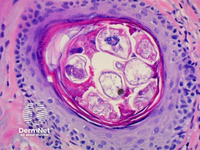 Demodex mite histology x400