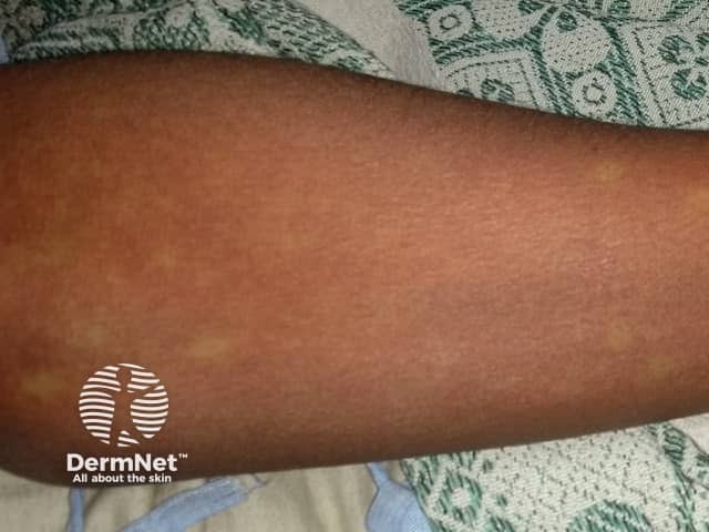 Dengue rash