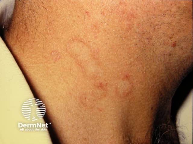 Dermal papules arranged in an annular distribution on a sun-damaged neck