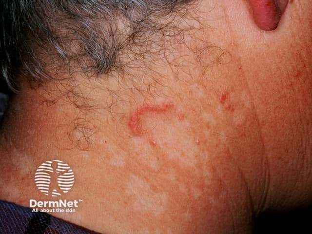 Dermal papules arranged in an annular distribution on the neck