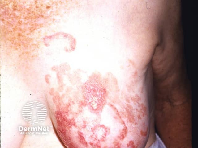 Mycosis fungoides