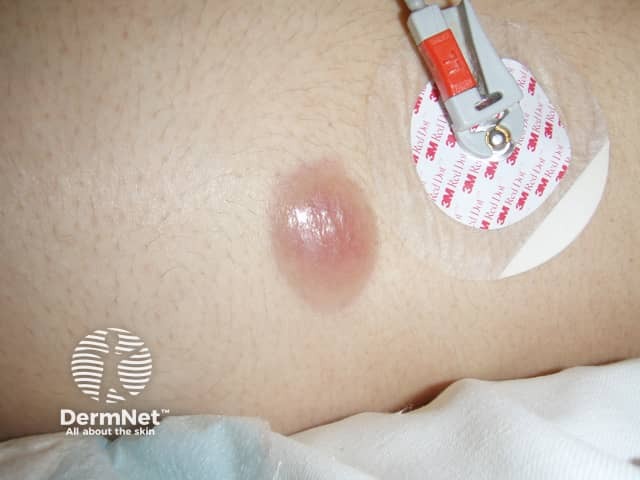 Leukaemia cutis