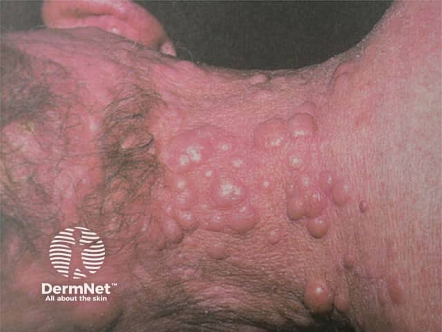 Cutaneous B-cell lymphoma