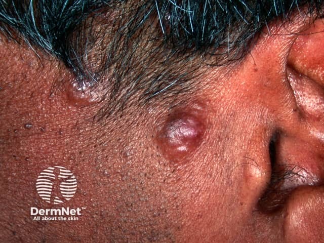 Cutaneous B-cell lymphoma