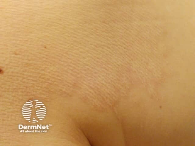 Mid-dermal elastolysis