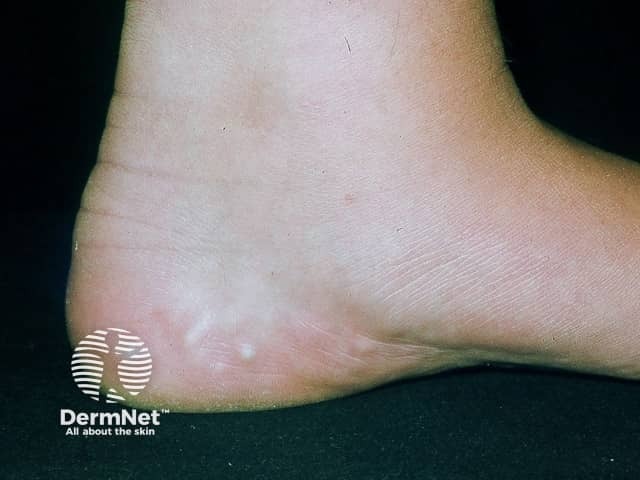 Piezogenic papules