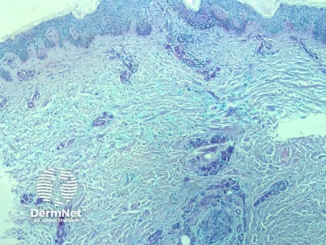 Positive mucin stain