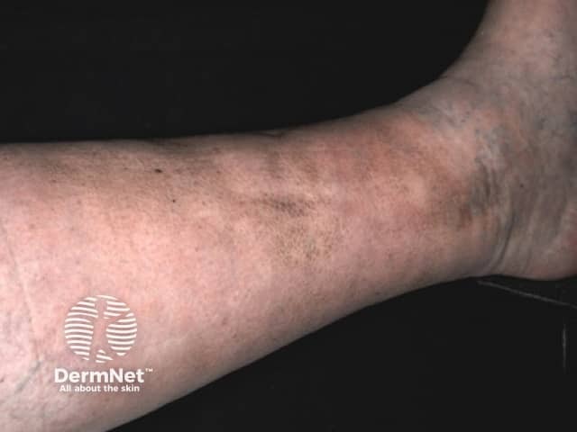 Pretibial myxoedema in Graves disease