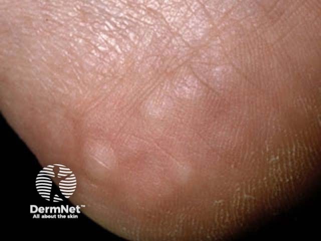 Piezogenic papules