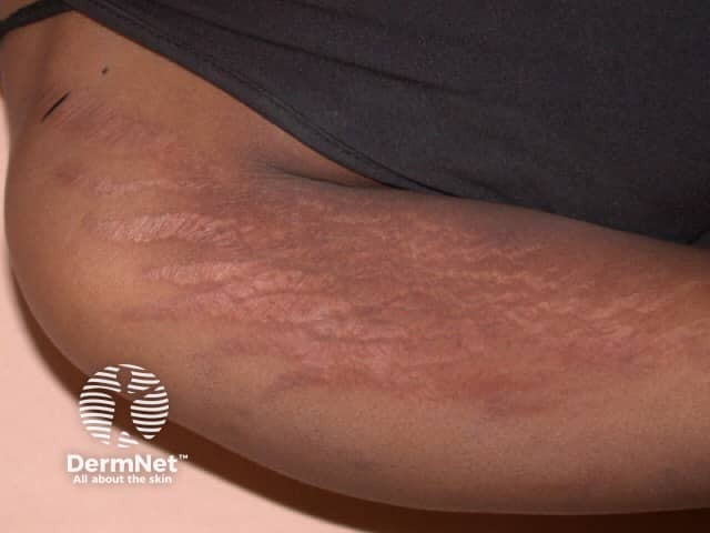 Stretch marks (striae)