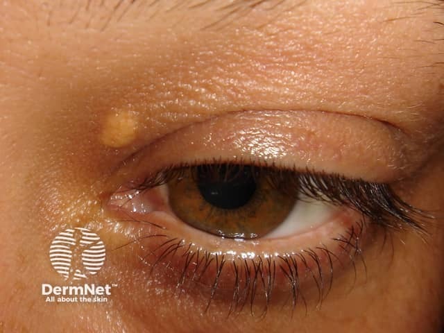 Xanthelasma