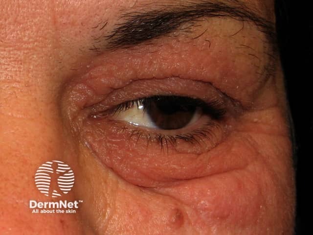 Contact allergic dermatitis around the eye