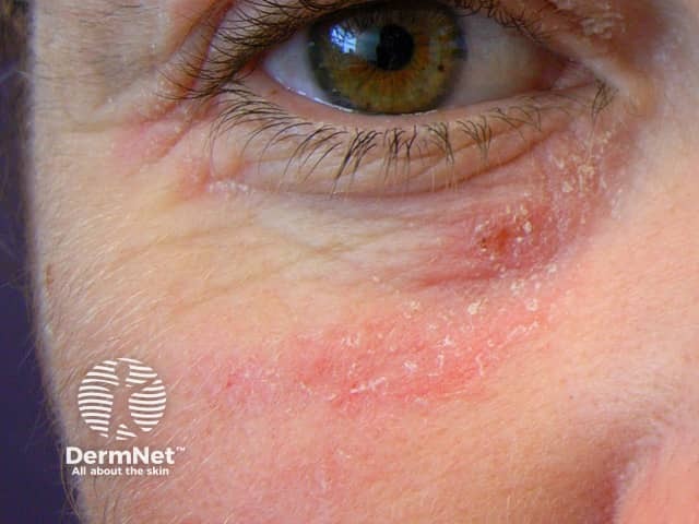 Contact allergic dermatitis under the eye