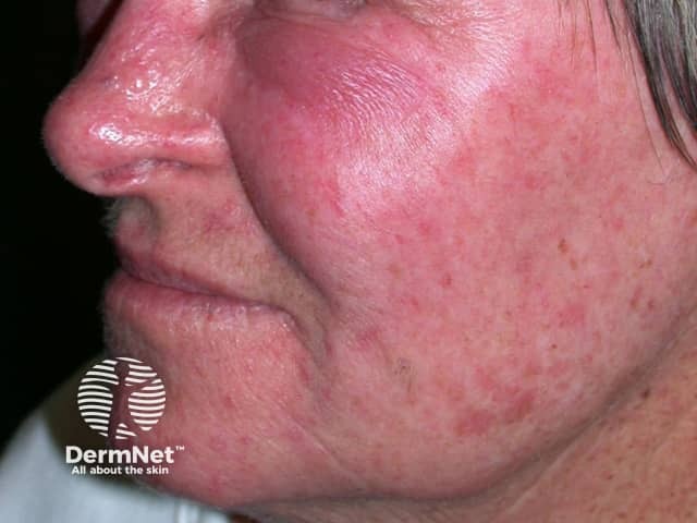 Contact allergic dermatitis