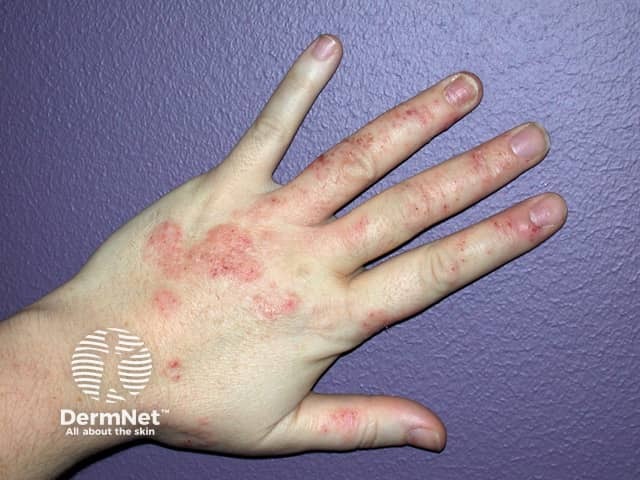 Contact allergic dermatitis of the hands