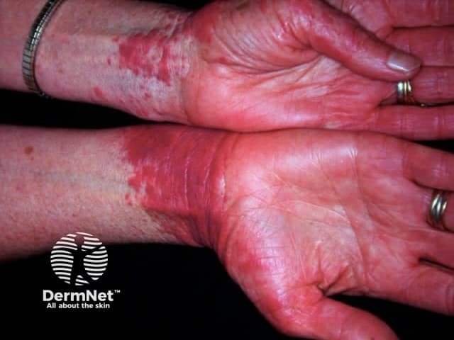 Contact allergic dermatitis of the hands