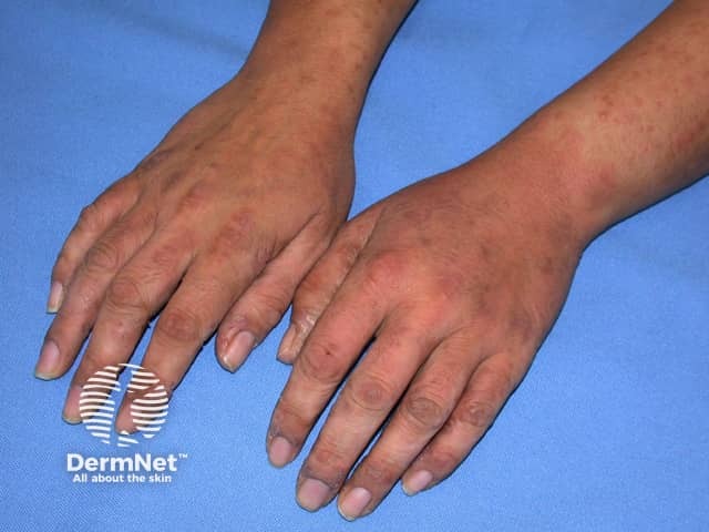 Contact allergic dermatitis of the hands