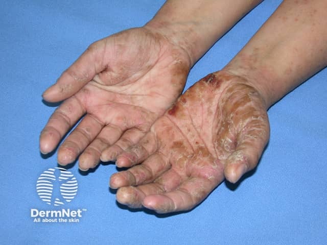 Contact allergic dermatitis of the hands