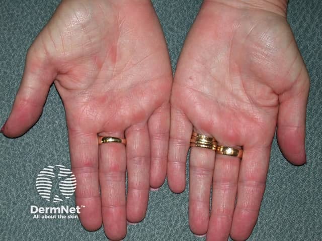 Contact allergic dermatitis of the hands