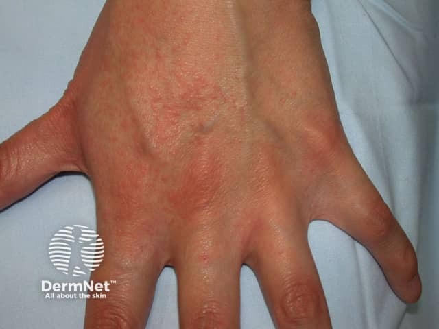 Contact allergic dermatitis of the hands