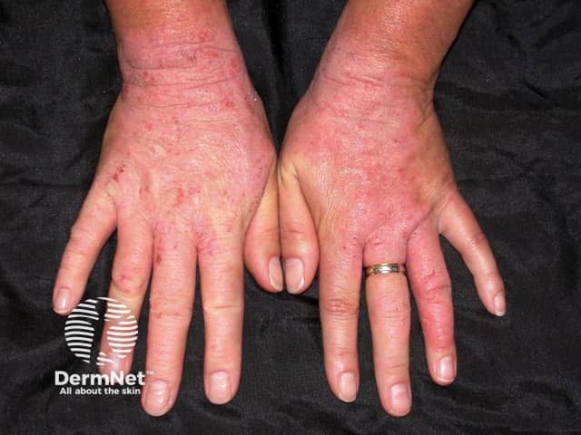 Contact allergic dermatitis of the hands