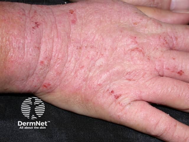 Contact allergic dermatitis of the hands