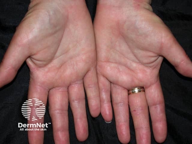 Contact allergic dermatitis of the hands