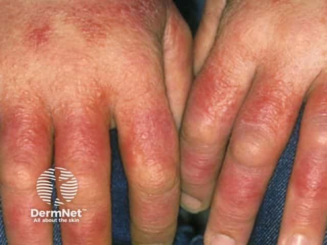 Contact allergic dermatitis of the hands