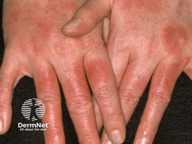 Contact allergic dermatitis of the hands