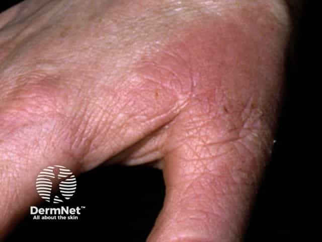 Contact allergic dermatitis of the hands