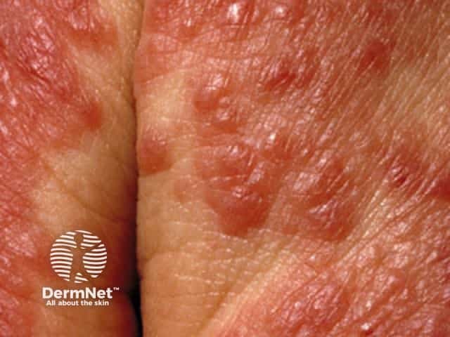 Contact allergic dermatitis of the hands