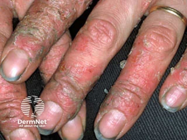 Contact allergic dermatitis of the hands