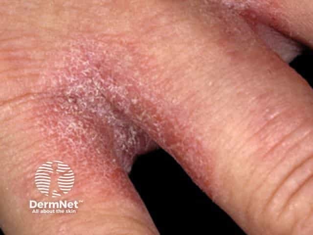 Contact allergic dermatitis of the hands