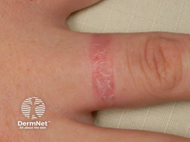 Contact allergic dermatitis of the hands