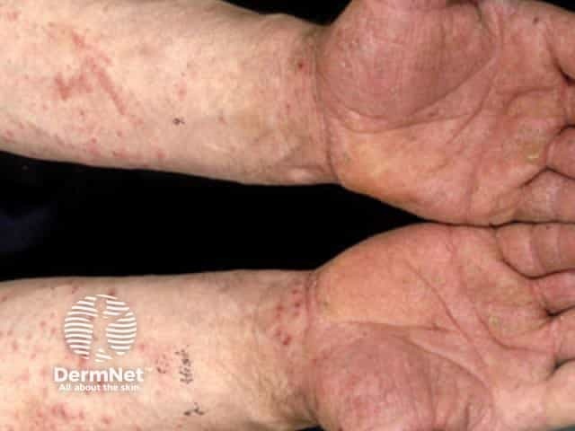 Contact allergic dermatitis of the arms and legs