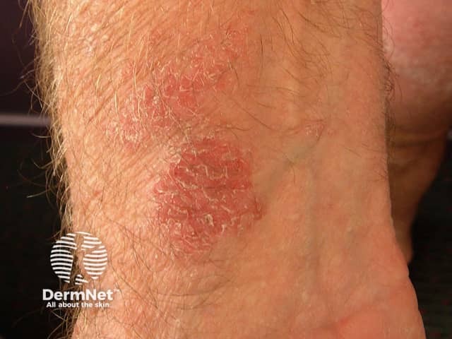 Contact allergic dermatitis of the arms and legs