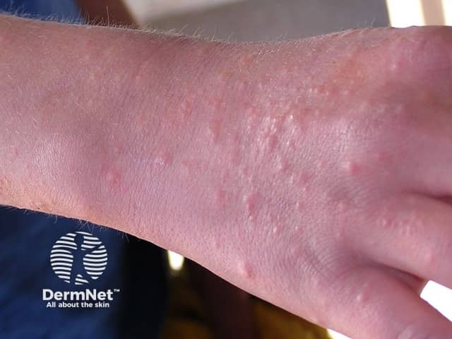 Contact allergic dermatitis of the arms and legs