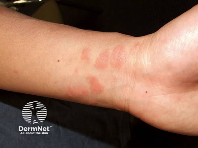 Contact allergic dermatitis of the arms and legs