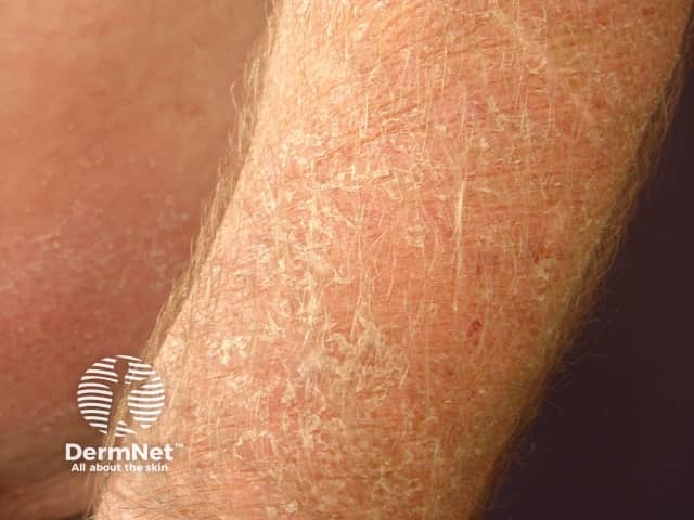 Contact allergic dermatitis of the arms and legs