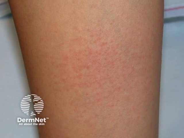 Contact allergic dermatitis of the arms and legs