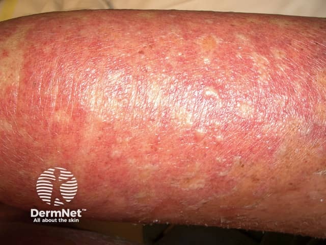 Contact allergic dermatitis of the arms and legs