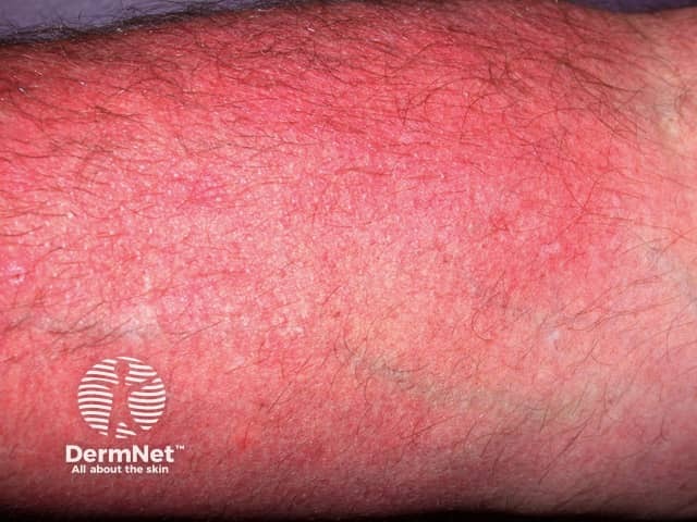 Contact allergic dermatitis of the arms and legs