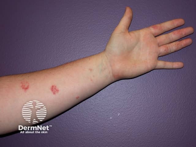 Contact allergic dermatitis of the arms and legs